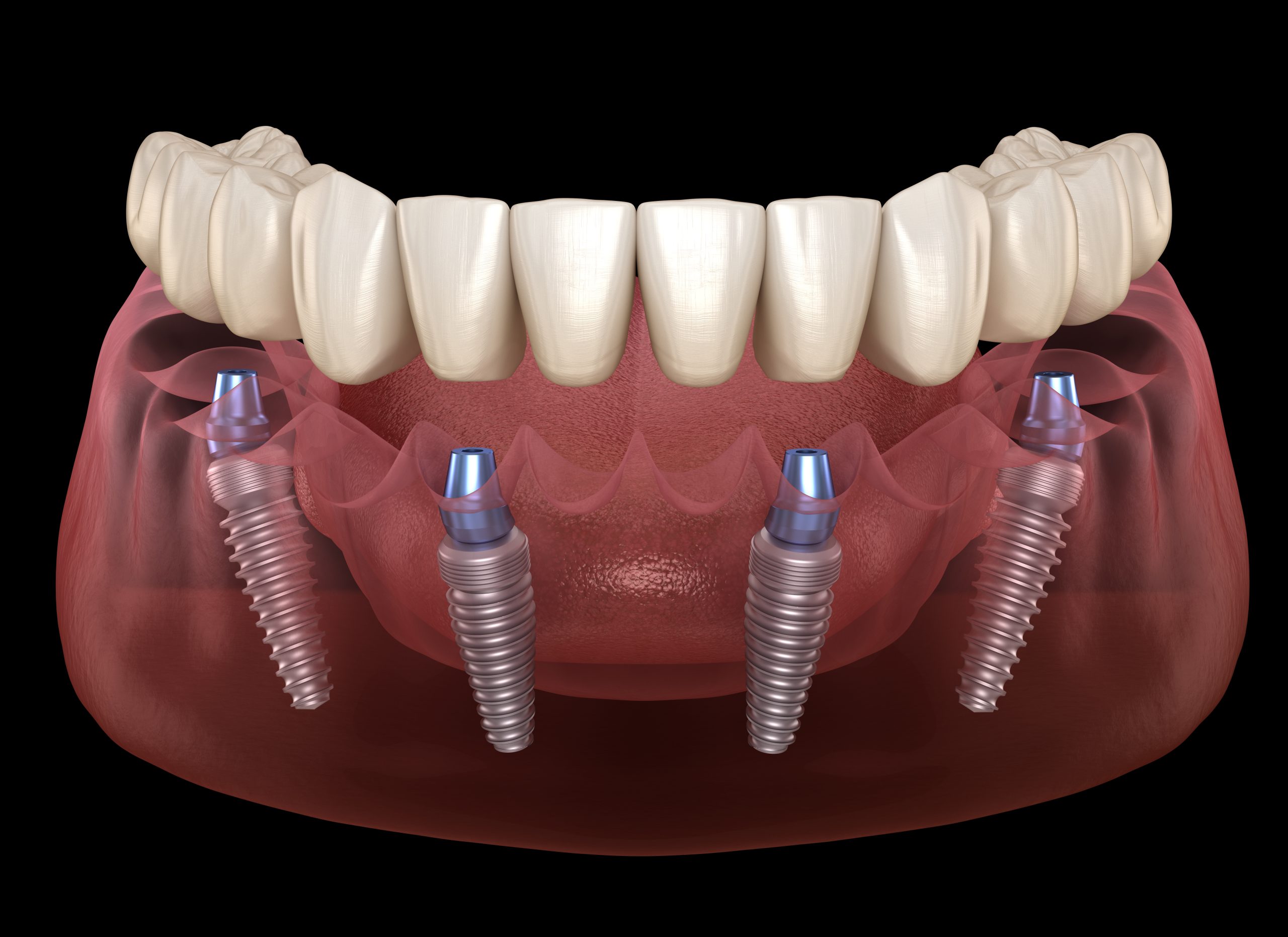 All on 4 Dental diagram